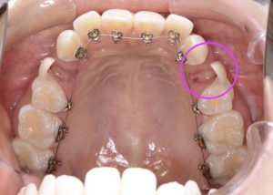 裏側矯正治療でダミーの歯をつけている写真