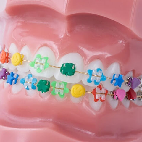 ワイヤー矯正の写真