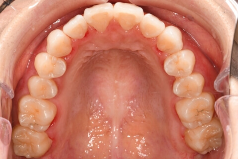 治療終了後の歯並び #01