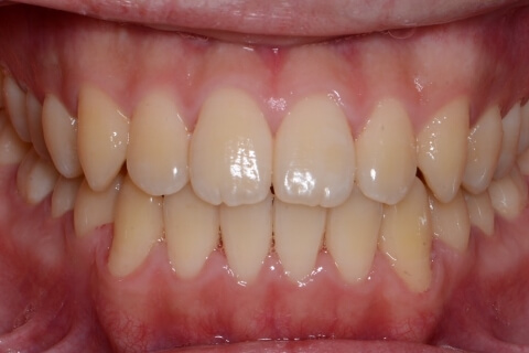 治療終了後の歯並び #02