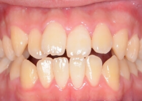 治療開始前の歯並び #02