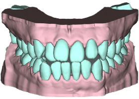 3Dスキャンをした歯並びの画像 #02