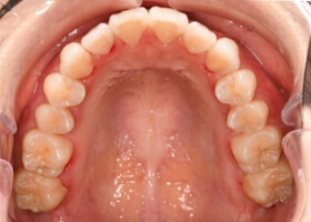 治療終了後の歯並び #01