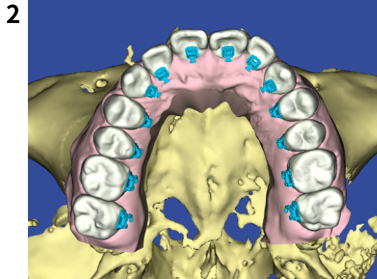 歯科用CTおよび3D口腔内スキャナーのデータからモデル化