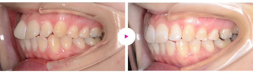 上下前歯の叢生や前方突出などの治療例（治療期間6ヶ月）