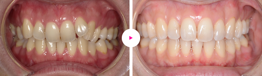 重症度の高い非抜歯の治療例（重度の前歯の凸凹（叢生）と奥歯の咬み合わせのズレ）