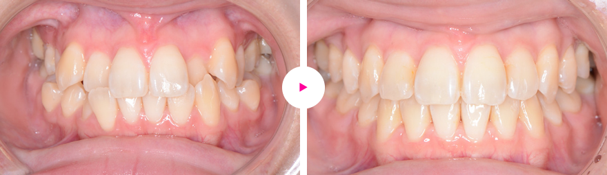 歯の凸凹（叢生）と八重歯の矯正治療例