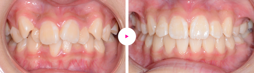 重度の歯の凸凹（叢生）と八重歯の治療例