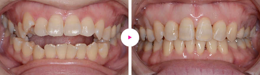 重度の開咬と前歯の突出（出っ歯）の矯正治療例