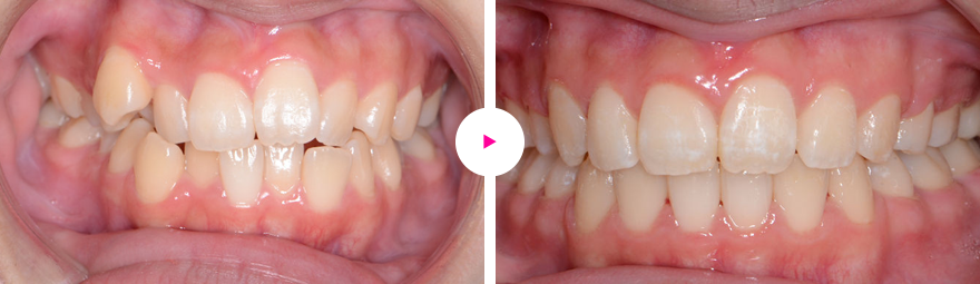 重度の歯の凸凹（叢生）、出っ歯（前方突出）、八重歯の治療例