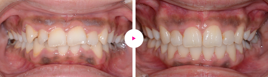 重度の出っ歯、口ゴボ、過蓋咬合の治療例