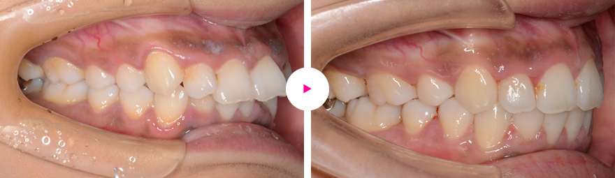 重度の出っ歯、口ゴボ、過蓋咬合の治療例