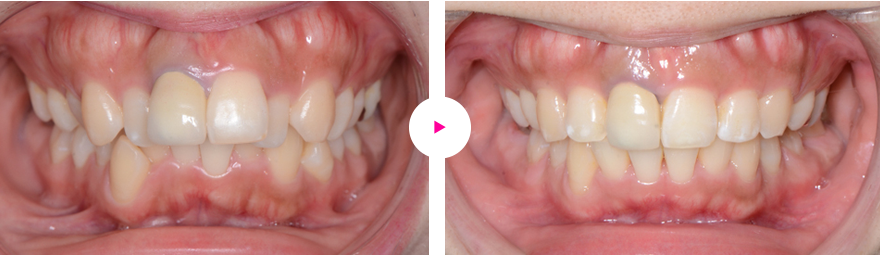 重度の下顎後退症、出っ歯、口ゴボ、口唇閉鎖不全の治療例