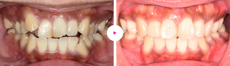 咬合平面の傾斜（cant）、ガタガタ歯、八重歯、口ゴボ、開咬の治療例