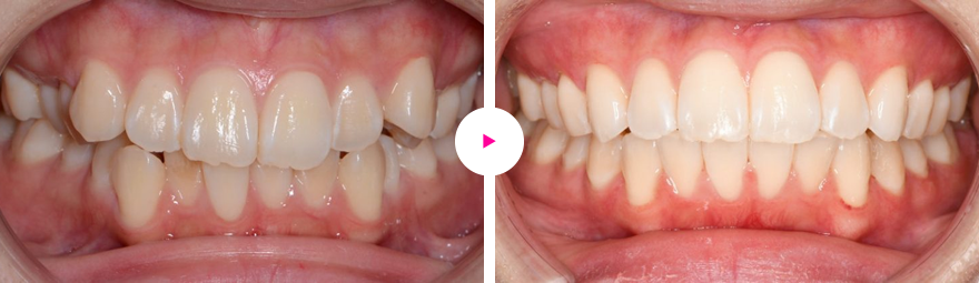 重度の凸凹歯（ガタガタ歯）と八重歯の矯正治療例