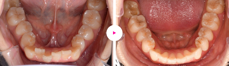 重度の凸凹歯（ガタガタ歯）と八重歯の矯正治療例