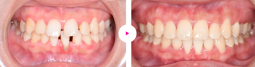 重度の歯肉退縮を伴う「すきっ歯」（空隙歯列）の治療例