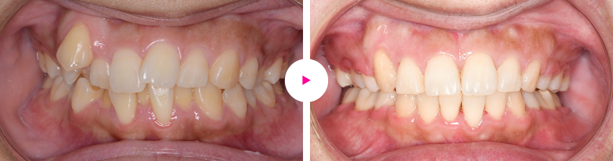 歯肉退縮を伴う重度の叢生（ガタガタ歯）の症例