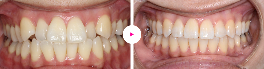 重度の口ゴボ（歯槽性の上下顎前突と口唇閉鎖不全）の矯正治療例