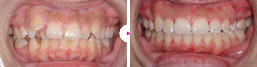 重度の出っ歯と凸凹（叢生）、八重歯の矯正治療例