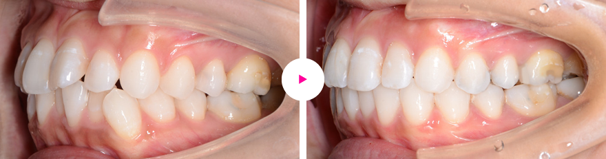 上下前歯の凸凹（叢生）のマウスピースによる矯正（治療期間6ヶ月）