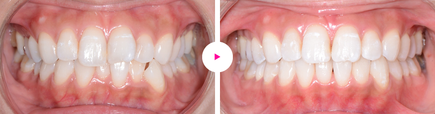 上下前歯の凸凹（叢生）のマウスピースによる矯正（治療期間6ヶ月）