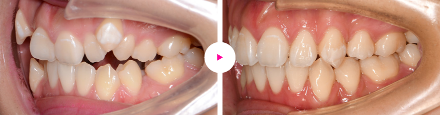 重度の八重歯とガタガタ歯（叢生：歯の凸凹）の治療例