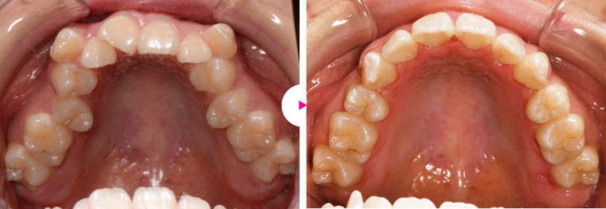 重度の八重歯とガタガタ歯（叢生：歯の凸凹）の治療例