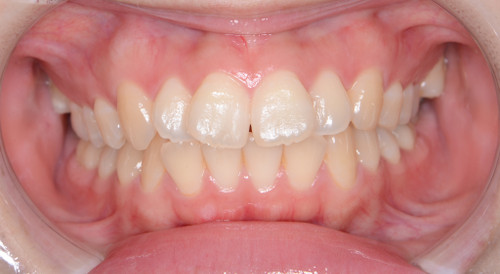 治療例001 - 正面から見た治療前の歯並び