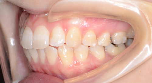 治療例001 - 右横から見た治療後の歯並び