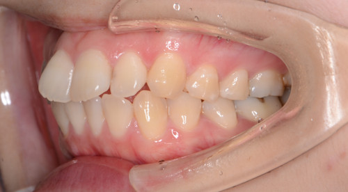 治療例001 - 右横から見た治療前の歯並び