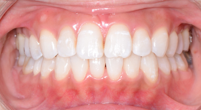 治療例002 - 正面から見た治療後の歯並び