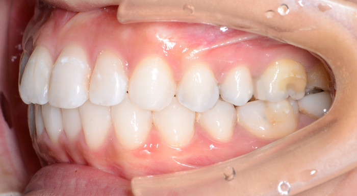 治療例002 - 右横から見た治療後の歯並び