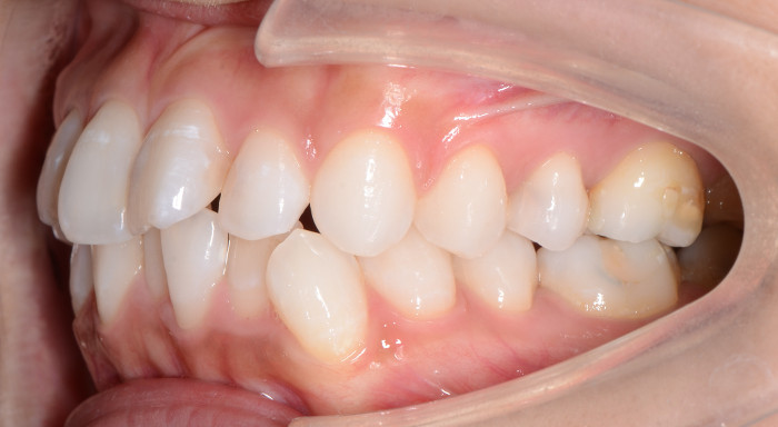 治療例002 - 右横から見た治療前の歯並び