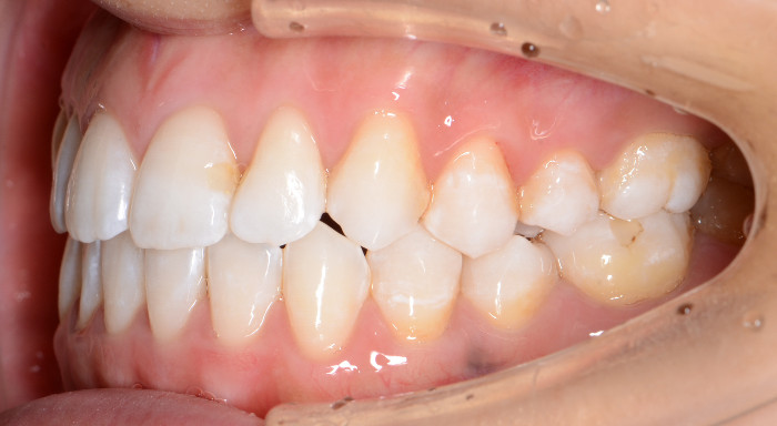 治療例003 - 右横から見た治療後の歯並び