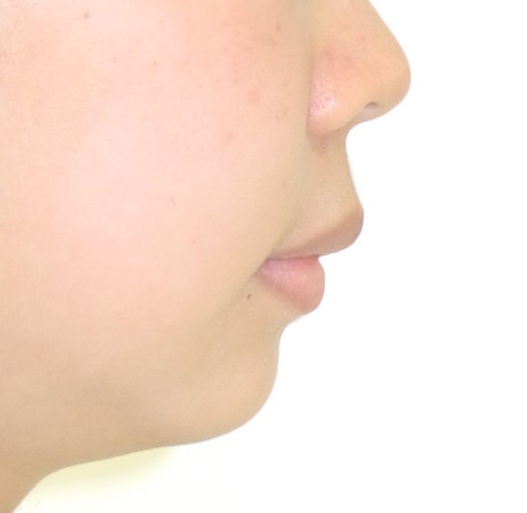 治療例004 - 左から見た治療後の横顔