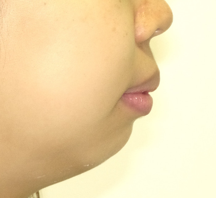 治療例004 - 左から見た治療前の横顔
