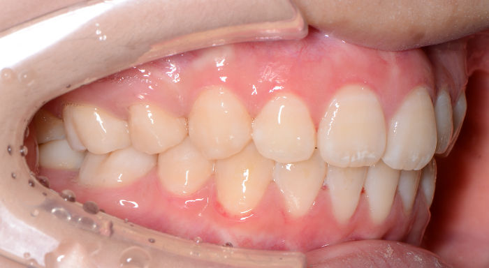 治療例004 - 左横から見た治療後の歯並び
