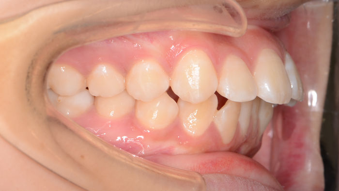 治療例004 - 左横から見た治療前の歯並び