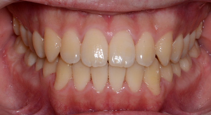 治療例005 - 正面から見た治療後の歯並び