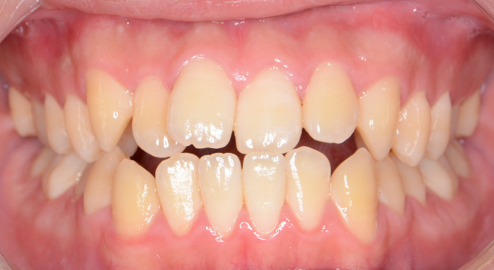 治療例005 - 正面から見た治療前の歯並び