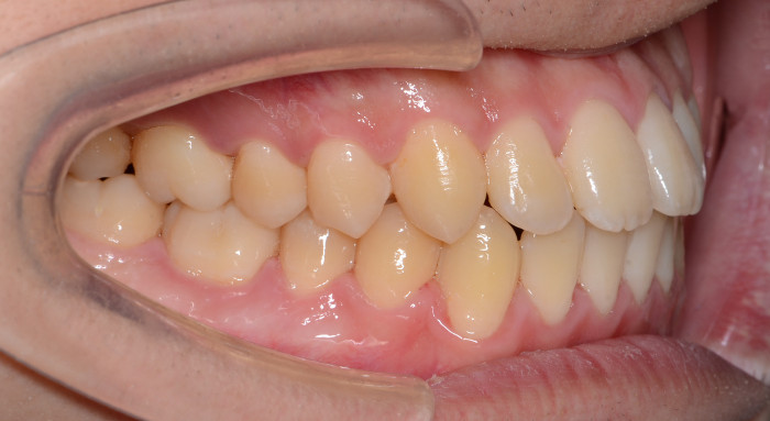 治療例005 - 左横から見た治療後の歯並び