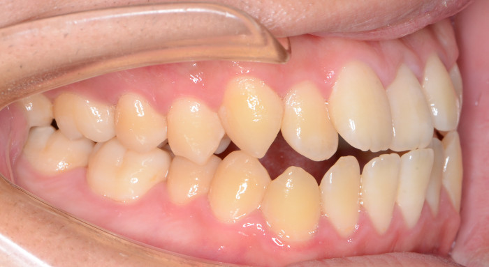 治療例005 - 左横から見た治療前の歯並び