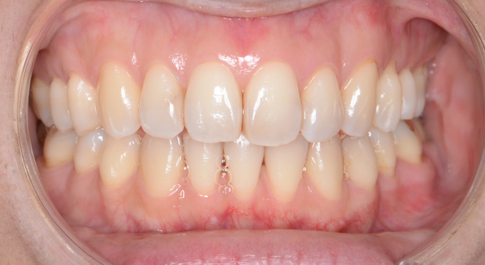 治療例006 - 正面から見た治療後の歯並び