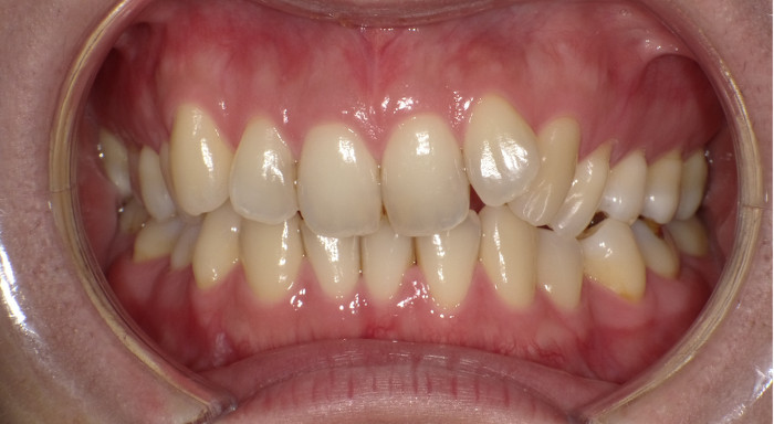 治療例006 - 正面から見た治療前の歯並び