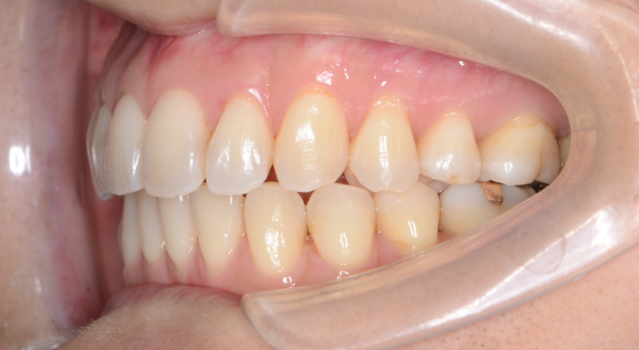 治療例006 - 右横から見た治療後の歯並び