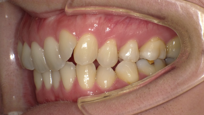 治療例006 - 右横から見た治療前の歯並び