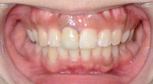治療例007 - 正面から見た治療後の歯並び