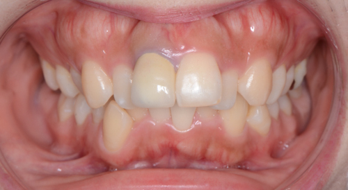 治療例007 - 正面から見た治療前の歯並び