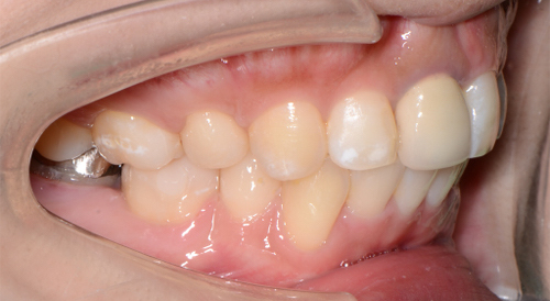 治療例007 - 左横から見た治療後の歯並び